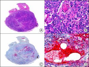 Sebaceous carcinoma. A, Low-power magnification (x10). B, High-power magnification showing findings indicative of sebaceous differentiation in the form of immature sebocytes and sebaceous ducts (×400). C, The same sample studied immunohistochemically with EMA (epithelial membrane antigen. Note the positive staining of the normal sebaceous glands of the dermis (positive internal control)(×10). D, High-power magnification of EMA-positive areas with more evident sebaceous differentiation (×400).