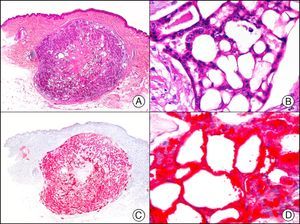 Primary cribriform primary carcinoma. A, Low-power magnification (×10). B, Detail of cribriform pattern of neoplastic epithelial islands (×400). C, The same sample studied immunohistochemically with CEA (carcinoembryonic antigen) (×10). D, Detail of CEA-positive neoplastic cells (×400).