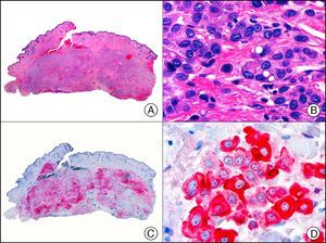 Primary histiocytoid cell carcinoma of the eyelid. A, Low-power magnification (×10). B, Detail of histiocytoid aspect of neoplastic cells, with several cells showing cytoplasmic vacuolization (×400). C, The same sample studied immunohistochemically with GCDFP-15 (gross cystic disease fluid protein 15) (×10). D, Detail of GCDFP-15-positive neoplastic cells (×400).