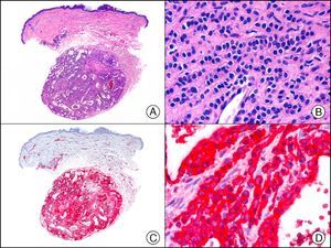 Cutaneous glomangioma. A, Low-power magnification (x10). B, High-power magnification of neoplastic cells around the vascular lumen, with round monomorphous nuclei and scant cytoplasm (×400). C, The same sample studied immunohistochemically with α-SMA (smooth muscle actin) (×10). D, Detail of α-SMA-positive neoplastic cells (×400).