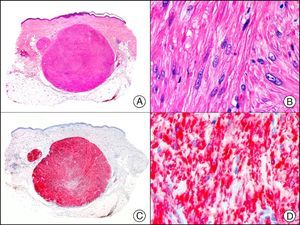 Cutaneous angioleiomyoma. A, Low-power magnification (×10). B, High-power magnification of neoplastic cells showing elongated nuclei with blunt ends and eosinophilic cytoplasm (×400). C, The same sample studied immunohistochemically with caldesmon (×10). D, Detail of caldesmon-positive neoplastic cells (×400).