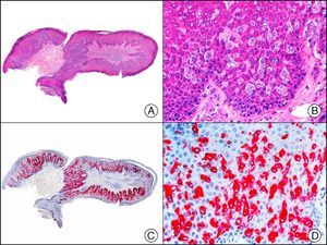 Extramammary Paget disease. A, Low-power magnification (×10). B, Detail showing numerous isolated large and atypical cells, with abundant basophilic cytoplasm, dotted throughout the epidermis (×400). C, The same sample studied immunohistochemically with CAM 5.2 (×10). D, Note the positive staining of neoplastic cells and negative staining of epidermal keratinocytes (×400).