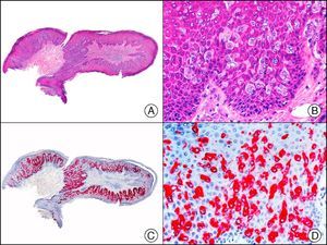 Extramammary Paget disease. A, Low-power magnification (×10). B, Detail showing numerous isolated large and atypical cells, with abundant basophilic cytoplasm, dotted throughout the epidermis (×400). C, The same sample studied immunohistochemically with CAM 5.2 (×10). D, Note the positive staining of neoplastic cells and negative staining of epidermal keratinocytes (×400).