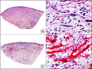 Cutaneous rhabdomyosarcoma. A, Low-power magnification (×10). B, Detail of neoplastic cells, showing atypical, elongated cells with a hyperchromatic nucleus (×400). C, The same sample studied immunohistochemically with myogenin (x10). Detail of myogenin-positive neoplastic cells (×400).