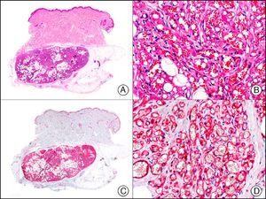 Infantile hemangioma in subcutaneous tissue. A, Low-power magnification (×10). B, High-power magnification of capillary vessels lined with monomorphous endothelial cells, without atypia (×200). C, The same sample studied immunohistochemically with CD31 (×10). D, Detail of CD31-positive endothelial cells lining the lumen of the capillary vessels (×200).