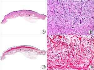 Plaque-like dermatofibroma. A, Low-power magnification of a lesion extending horizontally into the superficial dermis (×10). B, High-power magnification showing that the lesion is formed by spindle cells arranged in a storiform pattern around the vessels (×200). C, The same sample studied immunohistochemically with CD34 (×10). D, Detail of CD34-positive neoplastic cells (×200).