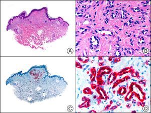 Lobular capillary hemangioma. A, Low-power magnification (×10). B, Detail of lesion showing capillary vessels lined by endothelial cells (×400). C, The same sample studied immunohistochemically with WT-1 (Wilms tumor 1) (×10). D, High-power magnification showing WT-1-positive nuclei in the proliferating endothelial cells (×400).