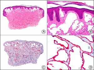 Superficial lymphatic malformation. A, Low-power magnification (×10). B, Detail of thin-walled dilated vessels lined with a discontinuous layer of flat endothelial cells occupying the superficial dermis (×200). C, The same sample studied immunohistochemically with podoplanin (×10). Detail of podoplanin expression in the cytoplasm of endothelial cells (×200).