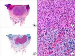Kaposi sarcoma, nodular stage. A, Low-power magnification (×10). B, High-power magnification of fascicles of spindle cells and small vascular spaces filled with red blood cells (×200). C, The same sample studied immunohistochemically with LYVE-1 (lymphatic vessel endothelial receptor 1) (×10). D, Detail showing LYVE-1-positive neoplastic cells (×200).