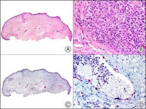 Intralymphatic histiocytosis. A, Low-power magnification (×10). B, Detail showing clusters of intravascular histiocytes (×200). C, The same sample studied immunohistochemically with PROX-1 (prospero-related homeobox 1) (×10). D, High-power magnification showing PROX-1 expression in nuclei of cells lining the vessels that contain histiocytes (×200). This positive staining demonstrates the lymphatic nature of the vessels.