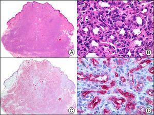 Infantile hemangioma. A, Low-power magnification (×10). B, High-power magnification of proliferating endothelial cells (×400). C, The same sample studied immunohistochemically with GLUT-1 (glucose transporter 1) (×10). D, Detail of GLUT-1-positive endothelial cells lining the lumen of the newly formed capillaries (×400).