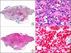 Angiosarcoma of the breast skin following radiation therapy for breast cancer. A, Low-power magnification (×10). B, Irregular vessels lined with atypical endothelial cells (×400). C, The same sample studied immunohistochemically for amplification of c-Myc (V-myc myelocytomatosis viral oncogene homolog [avian])(×10). D, Most of the nuclei of the neoplastic cells are strongly positive for c-Myc (×400).