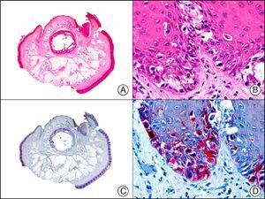 Subungual melanoma in situ. A, Low-power magnification (×10). B, High-power magnification showing numerous melanocytes with hyperchromatic pleomorphic nuclei in the basal and suprabasal layers of the epithelium (×400). C, The same sample studied immunohistochemically with Melan-A (×10). D, Detail of neoplastic melanocytes showing positivity for Melan-A (×400).