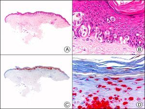 Melanoma in situ. A, Low-power magnification (×10). B, Isolated pagetoid melanocytes scattered through the basal and suprabasal layers of the epidermis (×200). C, The same sample studied immunohistochemically with HMB-45 (human melanoma black 45) (×10). D, Intense staining of neoplastic melanocytes scattered through the upper layers of the epidermis (×200).