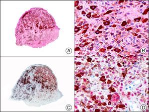 Blue nevi composed of epithelioid cells. A, Low-power magnification (×10). B, Epithelioid cells with abundant cytoplasm and containing abundant melanin pigment (×400). C, The same sample studied immunohistochemically with MiTF-1 (microphthalmia transcription factor 1) (×10). D, Detail showing positive staining for MiTF-1 in the nuclei of epithelioid melanocytes. Note the absence of staining in the nuclei of melanophages (×400).