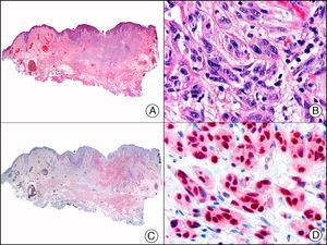 Desmoplastic melanoma. A, Low-power magnification (×10). B, Detail of neoplastic melanocytes in the reticular dermis (×400). C, The same sample studied immunohistochemically with SOX-10 (Sry-related HMG-BOX gene 10) (×10). D, Detail of SOX-10-positive nuclei in neoplastic melanocytes in the dermis (×400).