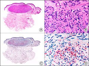 Palisading encapsulated neuroma. A, Low-power magnification (×10). B, Detail of neoplastic cells with spindle-shaped nuclei (×400). C, The same sample studied immunohistochemically with neurofilaments (×10). D, Detail showing staining for neurofilaments in the axons of the proliferating nerve fibers (×400).