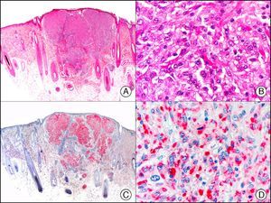 Cellular neurothekeoma. A, Low-power magnification (×10). B, Detail of neoplastic cells, showing vesicular nuclei and eosinophilic cytoplasm (×400). C, The same sample studied with PGP 9.5 (×10). D, Detail showing positive staining of neoplastic cells (×400).