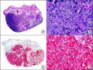 Merkel cell carcinoma. A, Low-power magnification (×10). B, Detail of neoplastic cells showing round nuclei with granular chromatin and numerous mitotic figures (×400). C, The same sample studied immunohistochemically with neuron-specific enolase (NSE) (×10). D, NSE-positive neoplastic cells (×400).