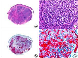 Merkel cell carcinoma. A, Low-power magnification (×10). B, Detail of neoplastic cells, showing round nuclei with granular chromatin (×400). C, The same sample studied immunohistochemically with chromogranin (×10). D, Detail of chromogranin-positive neoplastic cells (×400).