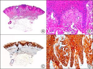 Lichen amyloidosis. A, Low-power magnification (×10). B, Detail of epidermal hyperplasia and deposits of amyloid substance in the papillary dermis (×200). C, The same sample stained with cytokeratin (CK) 903. Note the positive staining of both the epidermis and the amyloid substance in the papillary dermis, demonstrating its epithelial origin (×10). D, Detail of CK903-positive amyloid substance in the papillary dermis (×200).