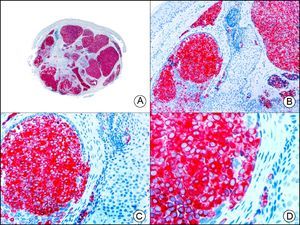 The same sample as that shown in Figure 39 but studied immunohistochemically with synaptophysin (A, ×10, B, ×40, C, ×200, D, ×400).