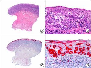 Epidermotropic metastasis from carcinoma of the bladder in the mucosa of the glans, mimicking extramammary Paget disease. A, Low-power magnification (×10). B, High-power magnification showing large cells with pleomorphic nuclei and abundant cytoplasm scattered through the epithelium (×400). C, The same sample studied immunohistochemically with cytokeratin (CK) 7 (×10). D, High-power magnification showing CK7 positivity in intraepithelial neoplastic cells (×400).