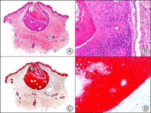 Poroma. A, Low-power magnification (x10). B, Detail showing that most of the neoplastic cells are poroid but also that there are some cuticular cells visible around a small duct (×200). C, The same sample studied immunohistochemically with cytokeratin (CK) 5/6 (×10). D, High-power magnification showing CK5/65 staining of neoplastic cells (×200).