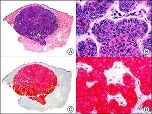 Basal cell carcinoma. A, Low-power magnification (x10). B, Detail showing islands of basaloid cells (×400). C, The same sample studied immunohistochemically with cytokeratin (CK) 14 (×10). D, High-power magnification of CK14–positive neoplastic cells (×200).