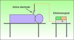 Bipolar circuit. The electric current flows between the 2 tines of the forceps (active electrode) without passing through the patient.