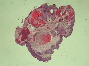Histological appearance of a lesion, showing a pedunculated papule with grossly dilated blood vessels. Signs of thrombosis and recanalization can be seen. Acanthosis and hyperkeratosis are present in the epidermis. Some vessels appear to be included within the epidermis. Hematoxylin-eosin, original magnification ×40.