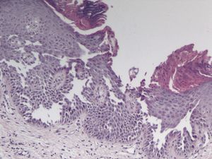 Mild epidermal hyperplasia with hyperkeratosis, parakeratosis, acanthosis, and focal acantholysis with suprabasal clefts. Hematoxylin-eosin, original magnification ×40.