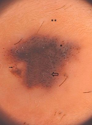 Dermoscopic picture (20×): central dark hyperpigmented area with a predominant globular pattern (thick arrow), an eccentric thickened pigment network (thin arrow) and a blue-whitish-veil (*), surrounded by a rim of thin regular pigment network (**).