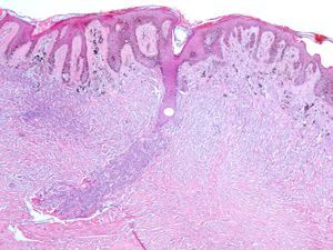 Histological picture (H&E, 4×): collision tumor of congenital nevus and dermatofibroma.