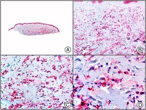 The same specimen as that shown in Figure 13 studied immunohistochemically with CD138. Note the expression of this marker in the neoplastic plasma cells.