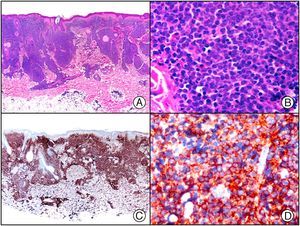 Cutaneous infiltration in chronic myeloid leukemia. A, Low-power magnification. B, Detail of myeloid cells infiltrating the dermis. C, The same specimen studied immunohistochemically with CD45. D, Detail of CD45-positive neoplastic cells.