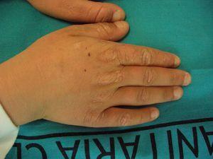 Localized waxy thickening in the interphalangeal and metacarpophalangeal joints as a chronic cutaneous sign of erythropoietic protoporphyrin.