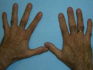 Male patient with a mild form of congenital erythropoietic protoporphyria. Note hypertrichosis is the only sign of the disease.