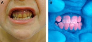A, Yellowish coloration of the teeth of a child with congenital erythropoietic porphyria. B, Red fluorescence (erythrodontia) can be readily observed under Wood light.