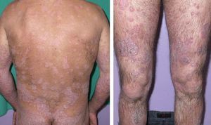 Widespread desquamating erythematous plaques prior to the onset of treatment with etanercept.