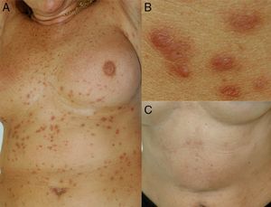 A, Multiple yellowish-brown papular lesions on the patient's trunk. B, Detail of the lesions. C, Hyperpigmented scars after completion of the treatment.