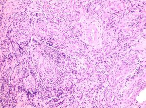 Significant neutrophilic infiltrate in the dermis with no granulomas or multinucleated giant cells. Hematoxylin-eosin, original magnification ×40.