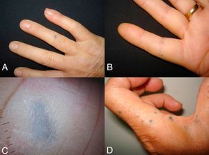 A and B, The first patient presented several blue-gray macules on the dorsum of the fourth finger of the right hand and on the palmar surface of the fifth finger of the right hand. C, Dermoscopy revealed a homogeneous blue-gray pattern. D, The second patient presented similar lesions on the dorsum of both hands.