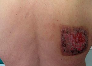 Erythematous plaque with an ulcerated center on the right side of the back.