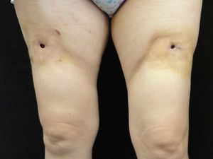 Indurated erythematous plaques with ulcerated centers on the front of both thighs.