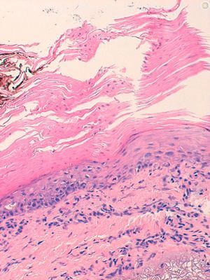 Hematoxylin–eosin, original magnification ×20. Cornoid lamella (column of parakeratosis associated with hypogranulosis and dyskeratosis.