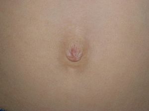 Small lesions in the form of angiokeratomas around the umbilicus (patient #1).
