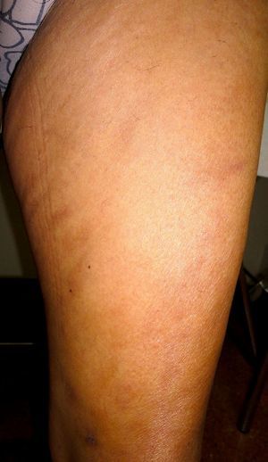 Oval, pigmented macules with poorly defined margins on the anteromedial aspect of the thigh.