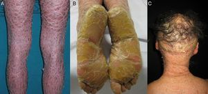 Clinical features of lamellar ichthyosis. A, Brownish lamellar desquamation. B, Marked plantar hyperkeratosis. C, Scarring alopecia of the scalp.