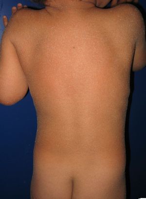 Patient with congenital ichthyosiform erythroderma and mutations in the ALOXE3 gene. Mild erythema and generalized whitish furfuraceous desquamation can be seen.